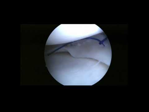Outside-In Single–Lasso Loop Technique for Meniscal Repair: Fast, Economic, and Reproducible