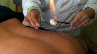Part 3 Fire Needle Acupuncture: Treatment for Back Pain
