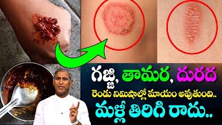 Best Natural Home Remedies For RINGWORM TREATMENTS | Dr Manthena Satyanarayana | GOOD HEALTH