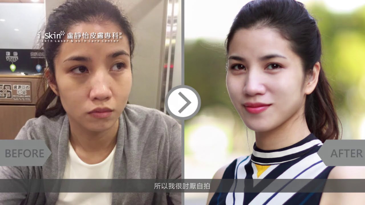 iSKIN盧靜怡皮膚專科診所【玻尿酸】歐美街拍名模範兒護理師_ Sherry