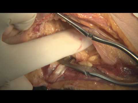 20 minuti contro cervicale osteocondrosi toracica Dolore osteocondrosi cervicale al collo per fare