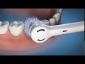 How to use the Waterpik™ Complete Care 5.5 Toothbrush - White
