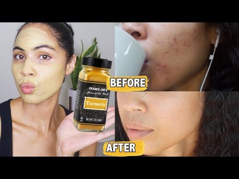 download lagu mp3 mp4 How To Use Turmeric Powder For Acne, download lagu How To Use Turmeric Powder For Acne gratis, unduh video klip How To Use Turmeric Powder For Acne