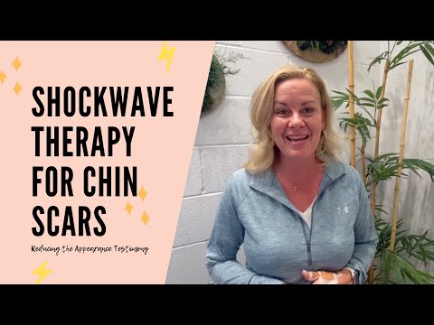 Shockwave Therapy for Chin Scar Treatments | Client Testimony