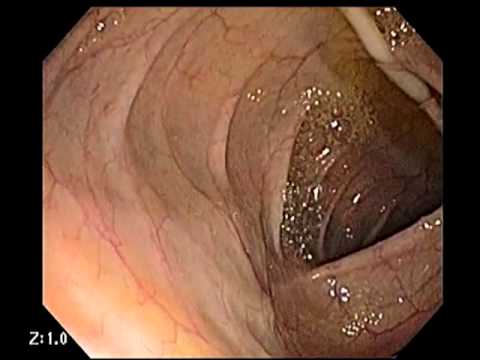 Immunmoduláció filarialis paraziták által