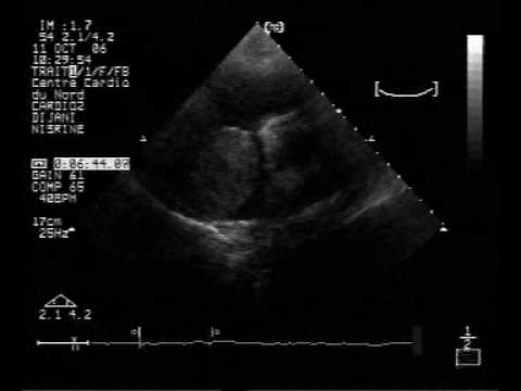 Large Right Atrial Tumor (2/2)