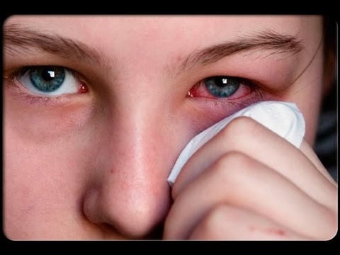 Come prendere la chilocaloria su uova un verme Come lottare con parassiti di viole