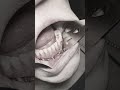 All-On-4 Dental Implant FAILURE