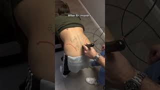 Shockwave Therapy Fixes Chronic Back Pain