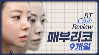 매부리코 9개월차 케이스리뷰 ㅣ비티성형외과