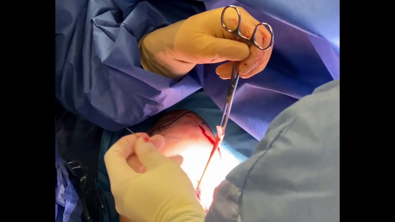 Dr. Garcia demonstrates his technique for subpectoral mini-open biceps tenodesis.