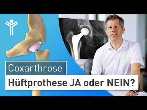 Artificial hip: Is total hip replacement useful for hip osteoarthritis? | Hip prosthesis