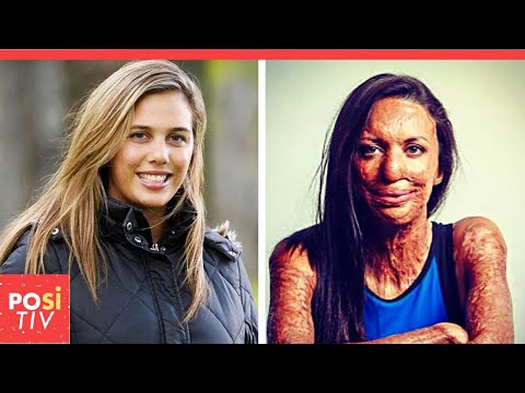 Die Frau, deren Körper mehr als 70 % verbrannt war und überlebte