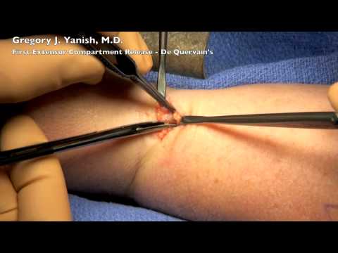 Wrist First Extensor Compartment Release - De Quervains Syndrome