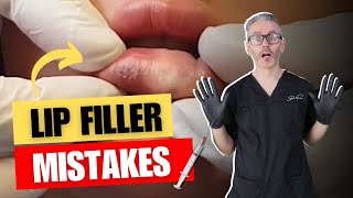 6 Lip filler Mistakes Injectors Make.