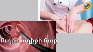 Ուղիղ աղիքի ճաք. միակ փրկությունը վիրահատությու՞նն է