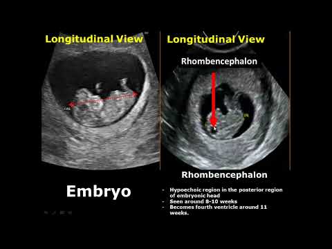 First Trimester & Ectopic Pregnancy Ultrasound Image Appearances