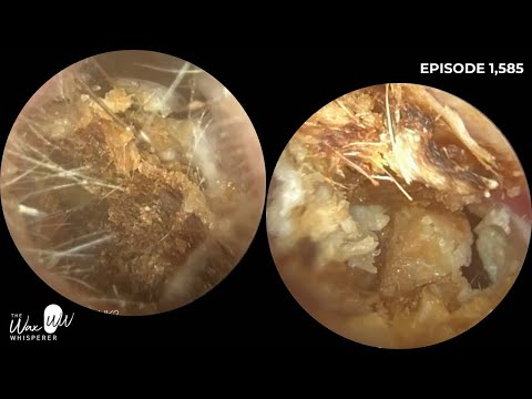 1,585 - Third Time Lucky Ear Wax Removal