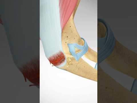 Elbow Olecranon Fracture and Fixation 3D Animation