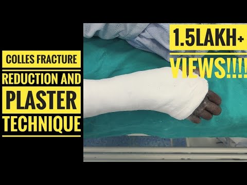 Colles Fracture Reduction and Plaster Technique