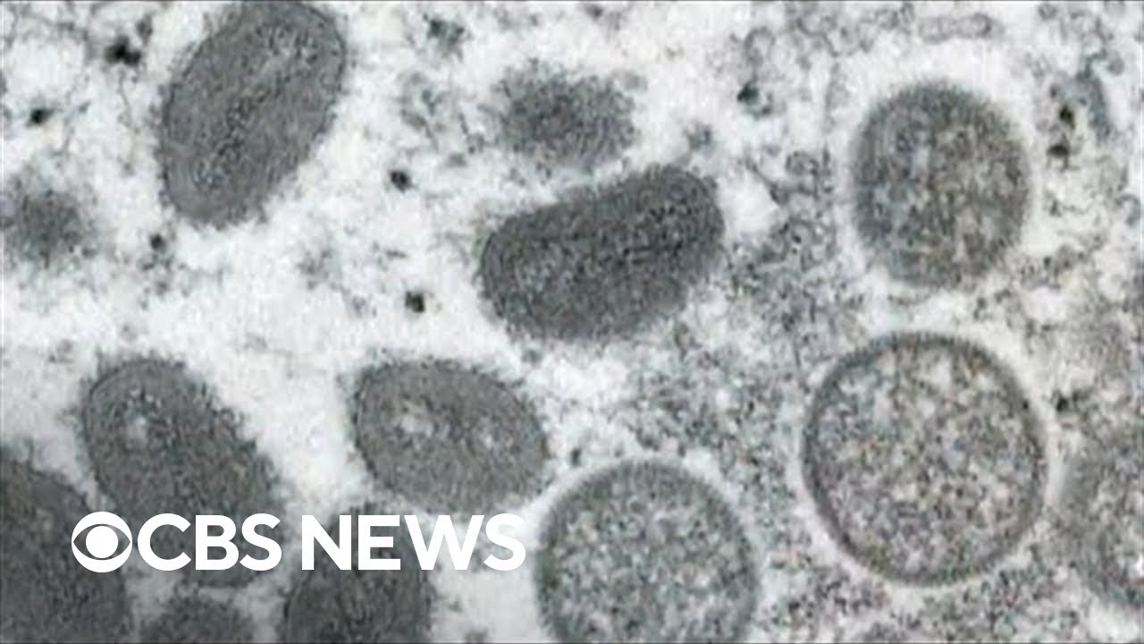 Officials urge public to remain calm as more monkeypox cases are investigated in the U.S.