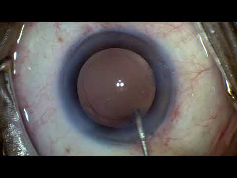 Bent Hydro Canula Clean The Posterior Capsule