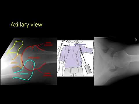 Proximal humerus fracture