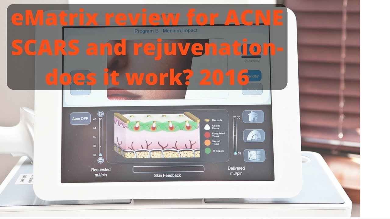 eMatrix for acne scars- in-depth review