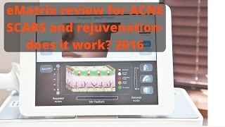 eMatrix for acne scars- in-depth review