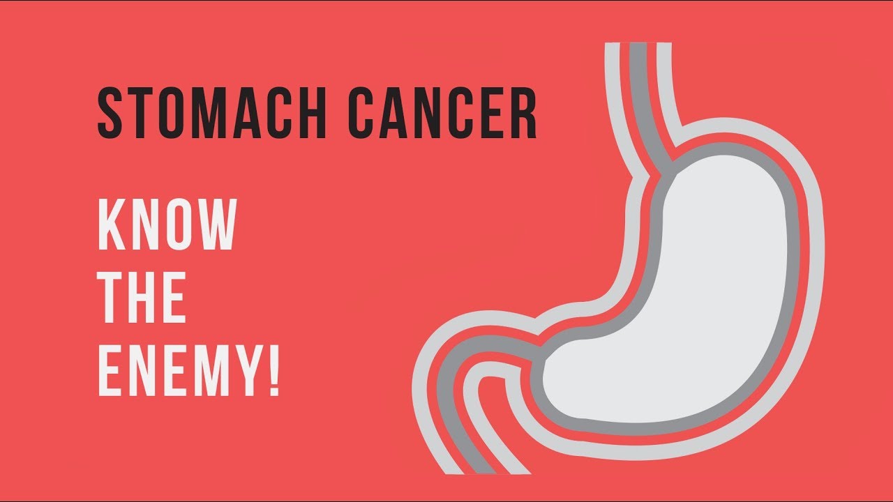 Stomach Cancer - Triggers, Symptoms, Treatments & Prevention