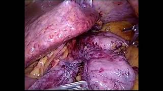 Versa Lifter Needle - Sleeve Gastrectomy