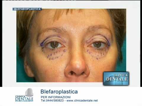 Da ginnastica per la persona ebbi rughe Ragioni di hypostasis di occhi e labbra