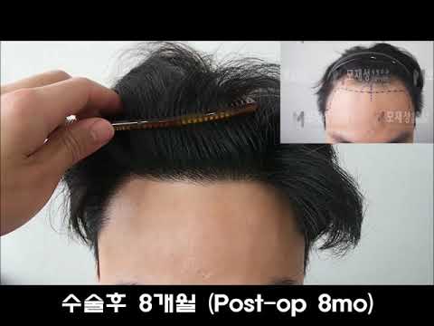 #비절개모발이식 #모재성성형외과 비절개모발이식으로 수술하신 남성분입니다