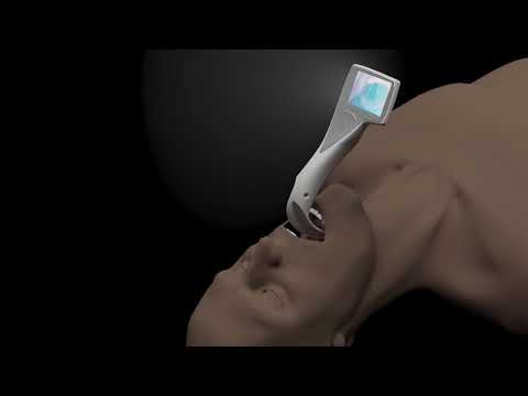 i-view™ video laryngoscope - features and benefits