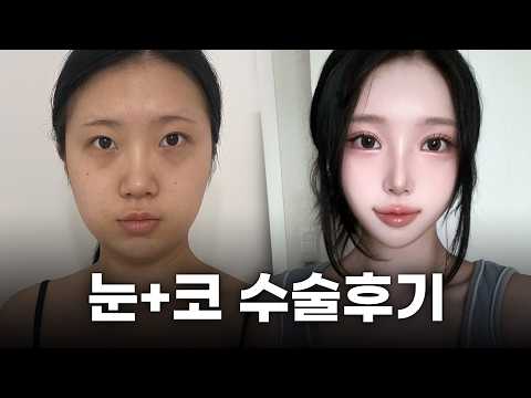 콤플렉스투성이 얼굴 환골탈태! 이마거상+눈+코 브이로그ㅣ디에이성형외과ㅣ콤플렉스극복