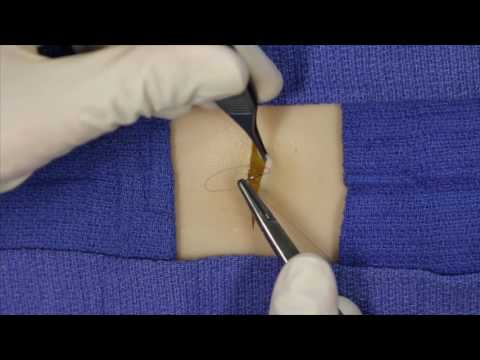 Buried vertical mattress suture technique