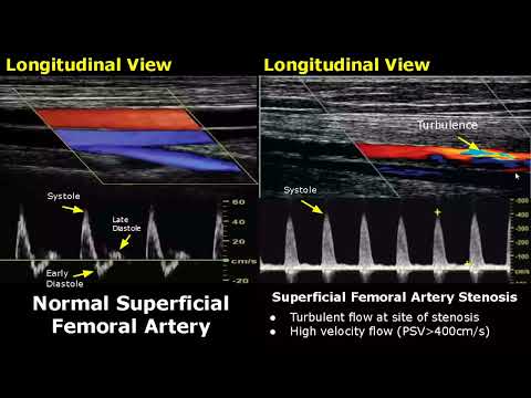 Femoral Artery Doppler Ultrasound Normal Vs Abnormal | Stenosis/Occlusion/Pseudoaneurysm/AVF USG