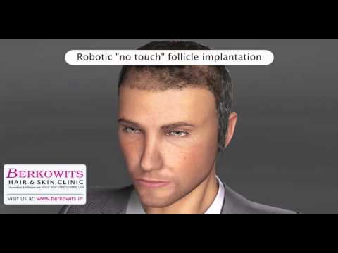 Robotic Hair Transplant Video | Hair Transplant Procedure