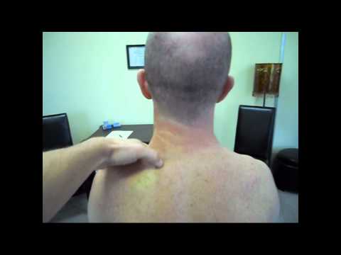 Neck Strain fixed with two Manual Therapy treatments
