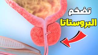 شاهد كيف يتم ازاله سرطان البروستاتا للرجال_Prostate cancer removal process