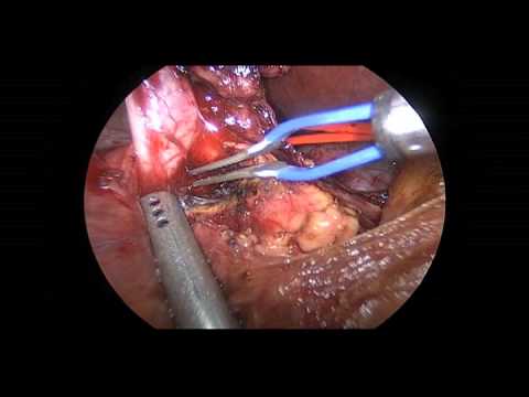 Laparoscopic Excision Of Type Ic Choledochal Cyst With Hepaticojejunostomy Reconstruction