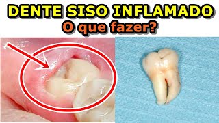 Dente do siso inflamado o que fazer