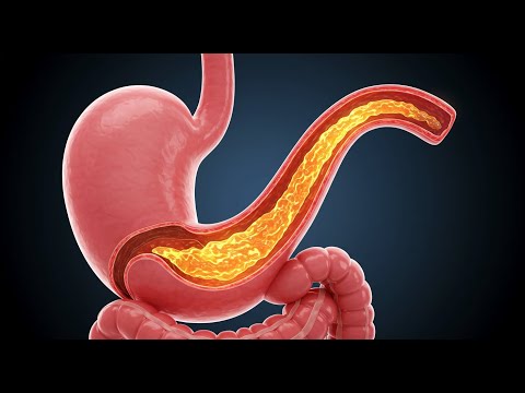 Treatment for gastroesophageal reflux disease (GERD)