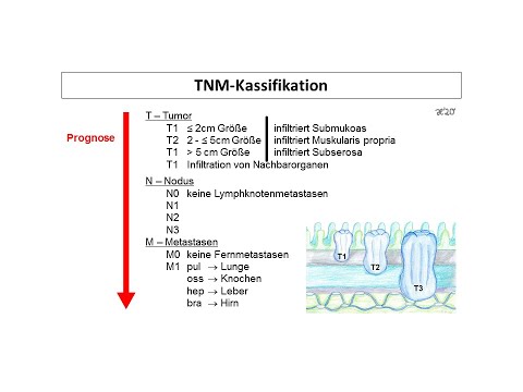 TNM-Klassifikation (Stadieneinteilung) | Strahlentherapie Prof. Hilke Vorwerk
