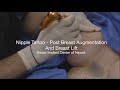 Nipple Tattoo Demo Video Post Breast Augmentation By The Breast Implant Center Of Hawaii