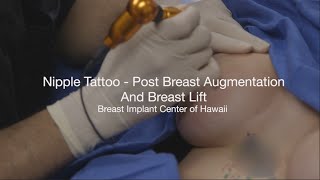 Download lagu Nipple Tattoo Demo Video, Post Breast Augmentation by The Breast Implant Center of Hawaii mp3