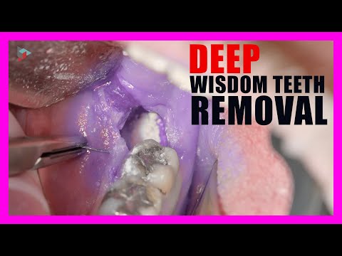 Wisdom Teeth Removal | Tooth Sectioning Procedure (Surgery)