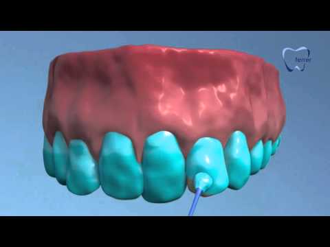 Blanqueamiento dental