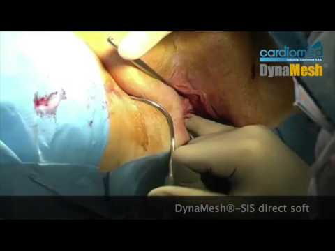 DynaMesh® SIS direct soft