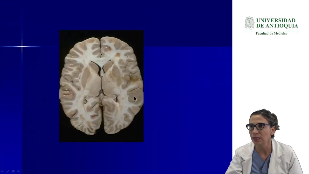Síndromes neurológicos - Dra. María E. Toro